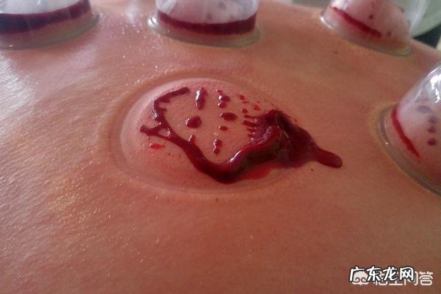 恶性肿瘤患者背部拔罐会怎么样?