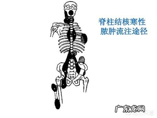 骨与关节结核对患者有哪些影响