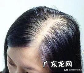 26岁女生,脱发如何解决?