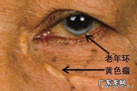 患有高血脂的人都有什么表现？