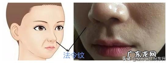 法令纹是怎么形成的？有方法改善吗？