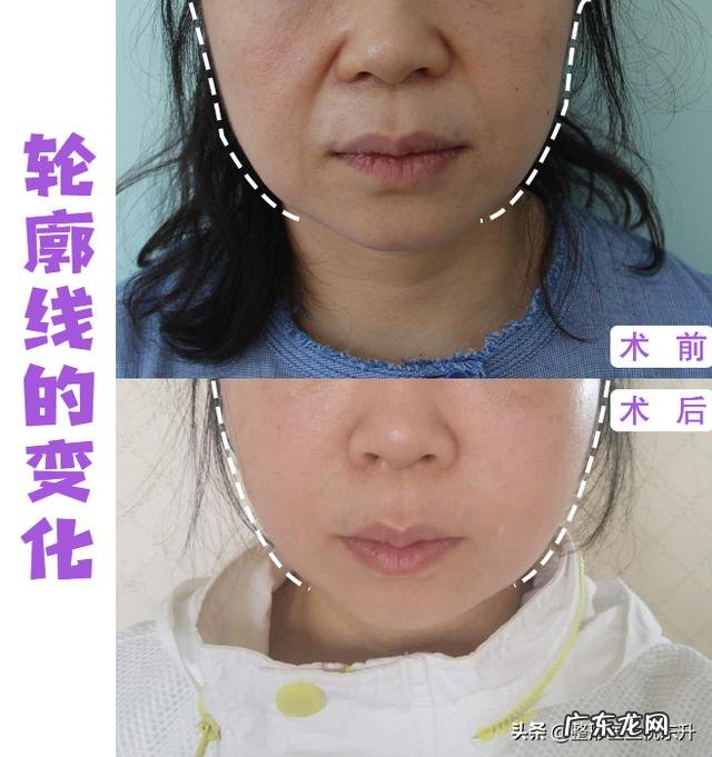 法令纹是怎么形成的？有方法改善吗？