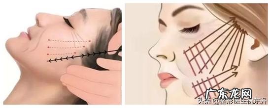 法令纹是怎么形成的？有方法改善吗？