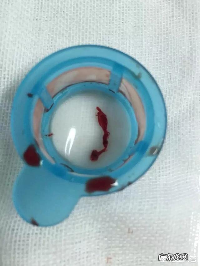 把血栓直接从血管里抽出来可行吗?为什么?