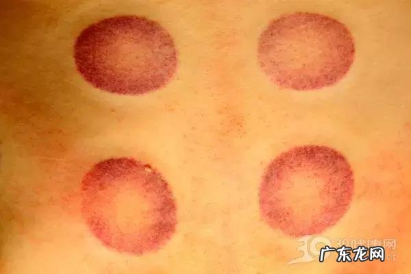 为什么肩膀拔罐特别黑 身上肩膀处每次拔罐都很黑怎么回事?