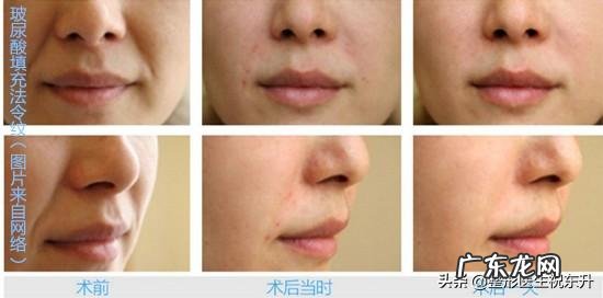 填充法令纹最好的方法 如何改善法令纹,填充和提升的效果真的好吗?