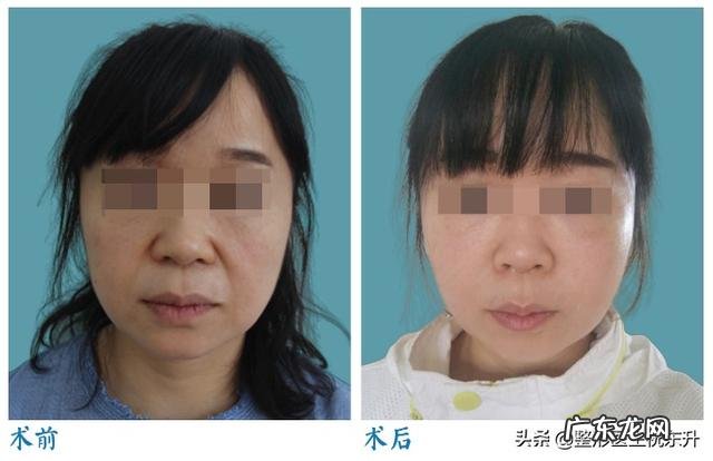 填充法令纹最好的方法 如何改善法令纹,填充和提升的效果真的好吗?