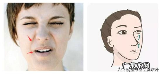 填充法令纹最好的方法 如何改善法令纹,填充和提升的效果真的好吗?