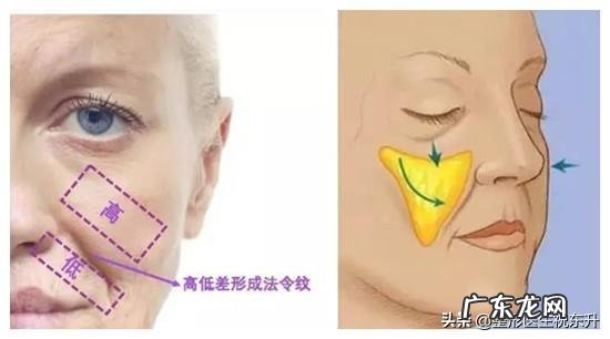 填充法令纹最好的方法 如何改善法令纹,填充和提升的效果真的好吗?