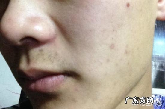 填充法令纹最好的方法 如何改善法令纹,填充和提升的效果真的好吗?