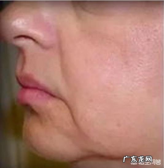 填充法令纹最好的方法 如何改善法令纹,填充和提升的效果真的好吗?