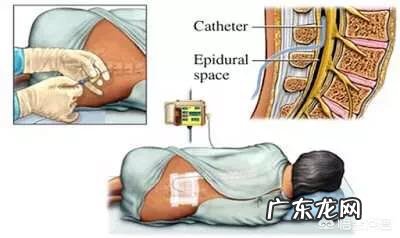无痛分娩麻醉会导致宫口不开宫缩无力吗会影响生产吗