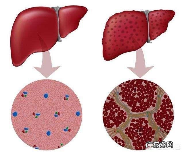 肝硬化出现癌变,身体会出现什么前兆?