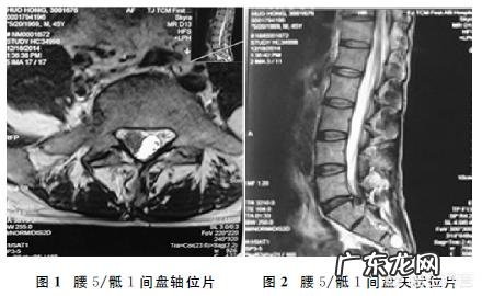 为什么腰肌力量大了就可以防止腰椎盘突出？