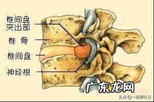 为什么腰肌力量大了就可以防止腰椎盘突出?