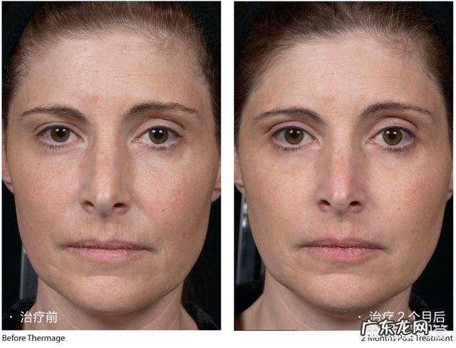 40+的女性长了法令纹怎样缓解或去除?