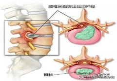 三十出头腰椎间盘突出，不能干重活，该怎么办