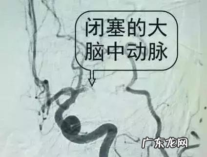 怎样才能“冲”走血栓,远离血栓?