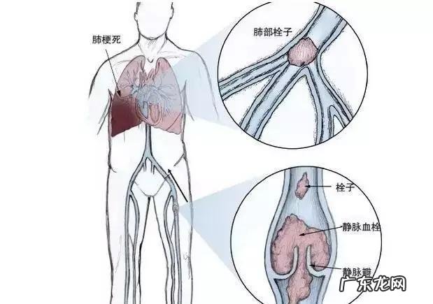 怎样才能“冲”走血栓,远离血栓?