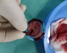 怎样才能“冲”走血栓，远离血栓？