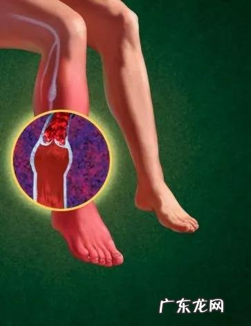 怎样才能“冲”走血栓,远离血栓?