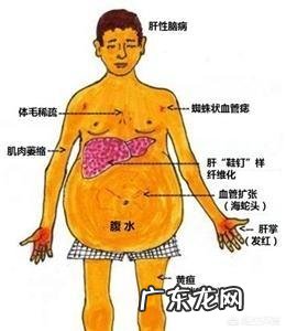 肝硬化到什么样程度才检查出是晚期?