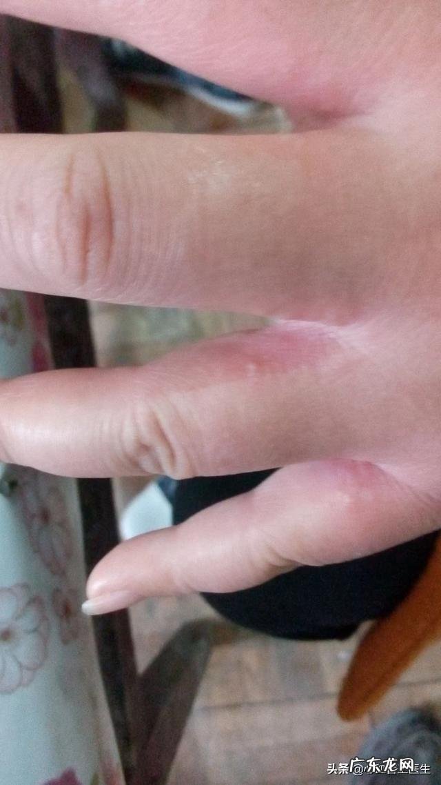 减重手术对糖尿病有效吗？做胃旁路手术价格？