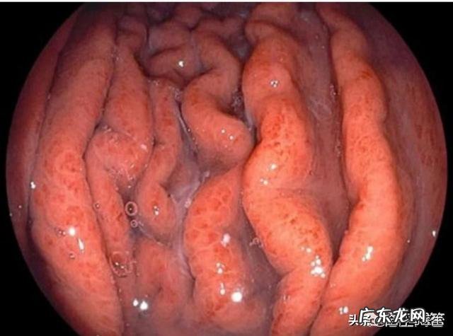 人为何会腹泻、便秘交替出现？ 为什么便秘的人会腹泻