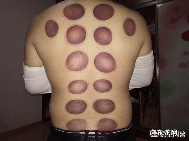 拔火罐对身体有什么作用?