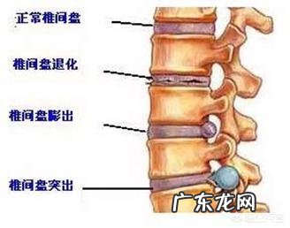 腰椎diyi节膨出可恢复吗?需要注意什么?