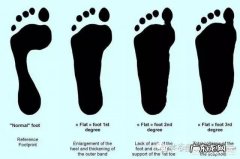 扁平足是怎么形成的，有办法改变吗？ 所有的扁平足都可以改善吗