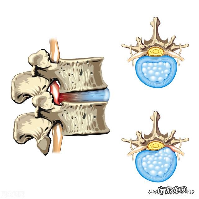 腰L4/5椎间盘膨出的患者需要注意什么,如何锻炼恢复?