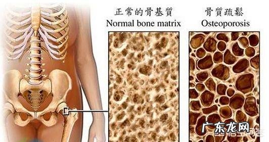 艾滋病病人为什么会出现骨质疏松?
