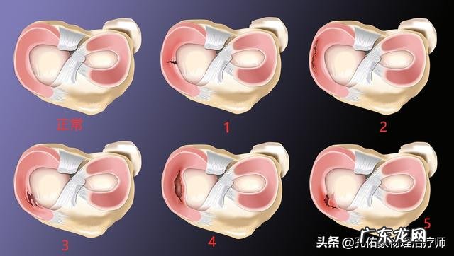 本人半月板损伤、膝盖积液,有没有可以代替跑步的有氧运动谢谢?