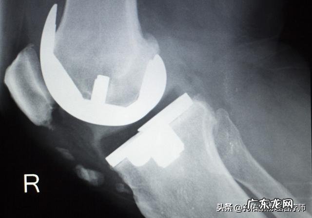 本人半月板损伤、膝盖积液,有没有可以代替跑步的有氧运动谢谢?