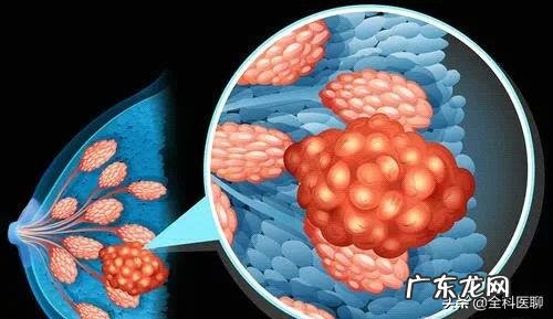 哪些人容易得乳腺癌?该如何diyi时间排查乳腺癌?