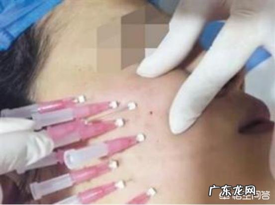 蛋白埋线提升对比图?蛋白埋线提升效果不同原因？