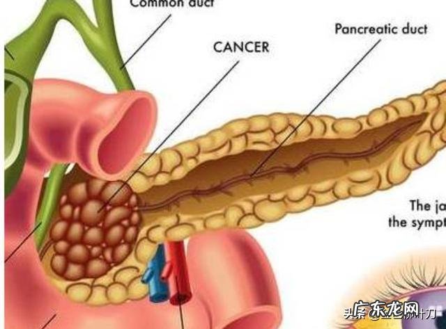 如何通过检查来发现胰腺癌怎样调理好身体