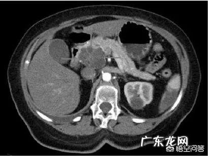 如何通过检查来发现胰腺癌怎样调理好身体
