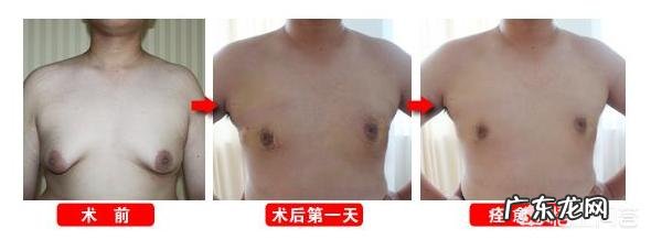 男人胸大如何瘦下去 男人太胖导致胸太大怎么瘦下去?