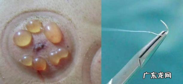 拔火罐起水泡,能勾破它吗?