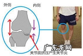 33岁的o型腿靠锻炼能矫正过来吗 O型腿,腿不直怎么办?能通过锻炼纠正吗?