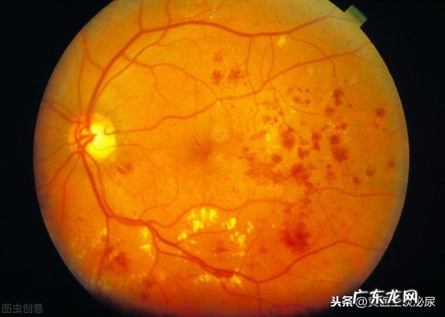 二型糖尿病人有什么办法可以恢复正常吗？