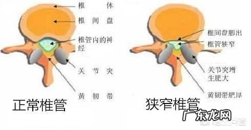 腰椎间盘突出真的需要卧床休息100天之久吗?