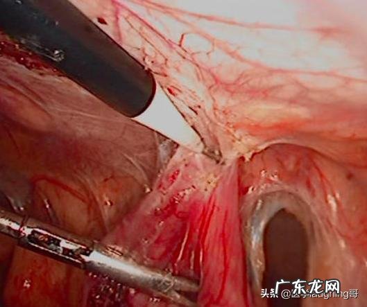 医生能检查出来肠粘连吗 几年前有个妇科医生说我有肠粘连请问严重吗?