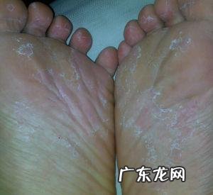 脚臭到底是哪些原因引起的?