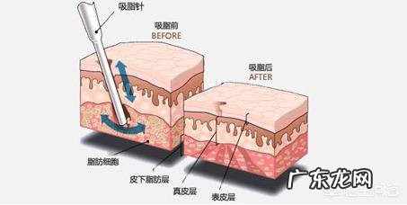 腰部吸脂后会提前松弛吗？
