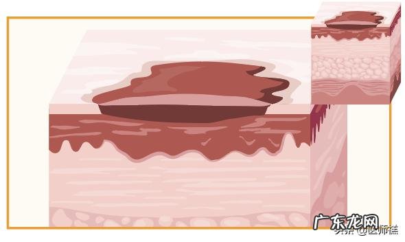 经常口腔溃疡,有什么方法缓解?