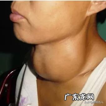 甲亢对生活有什么影响吗？