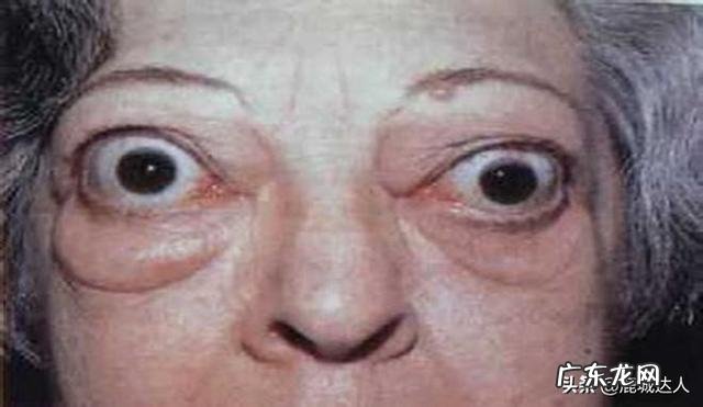 甲亢对生活有什么影响吗？